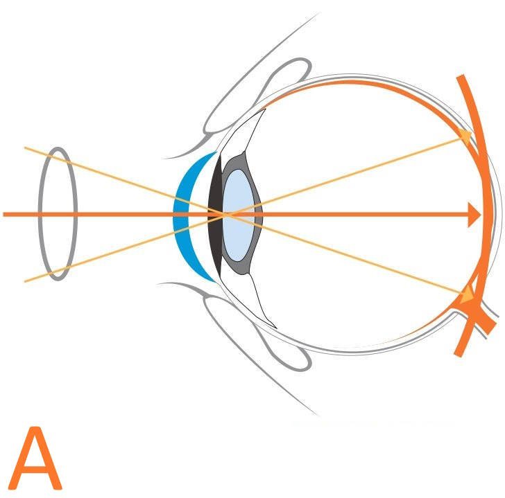 A Fascio-luminoso-lente-oftalmica-classica