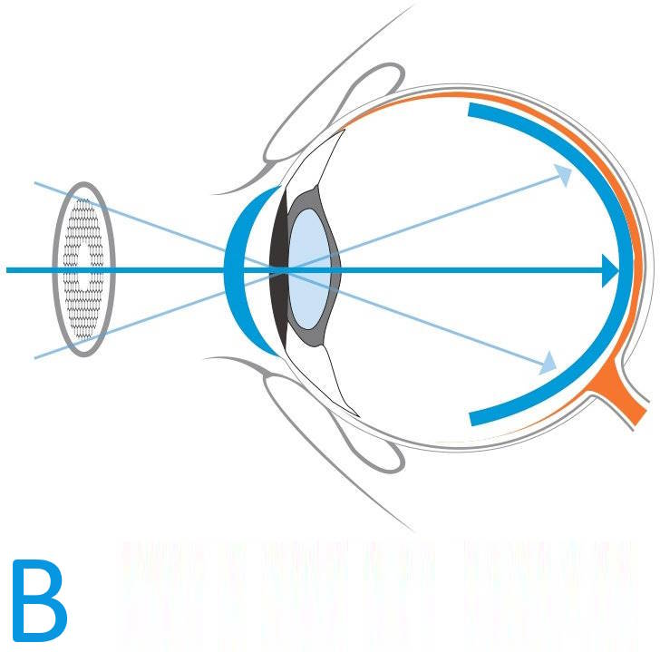 B Fascio-luminoso-lenti-oftalmiche-a-defocus-periferico